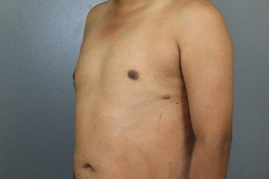 Gynecomastia Before & After
