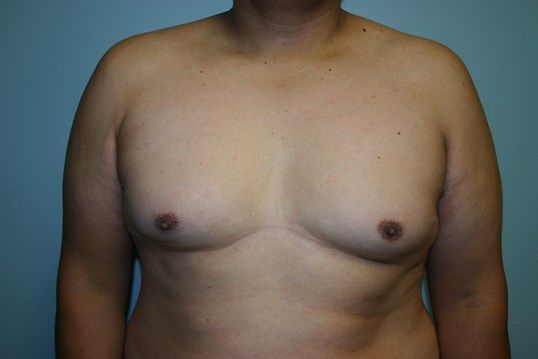 Gynecomastia Before & After