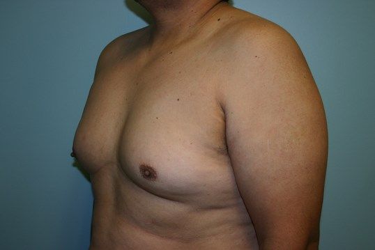 Gynecomastia Before & After