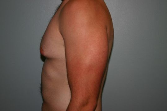 Gynecomastia Before & After