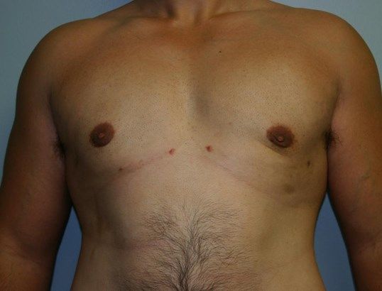 Gynecomastia Before & After