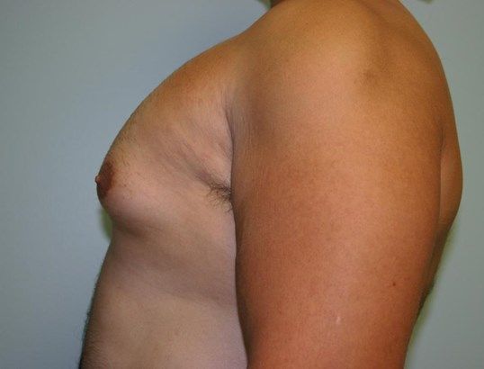Gynecomastia Before & After