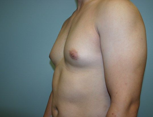 Gynecomastia Before & After