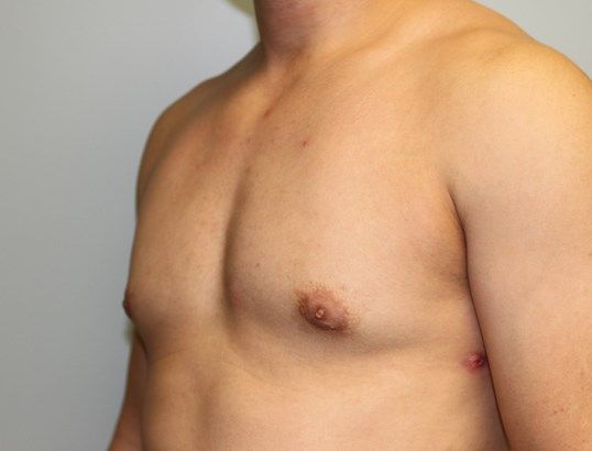 Gynecomastia Before & After
