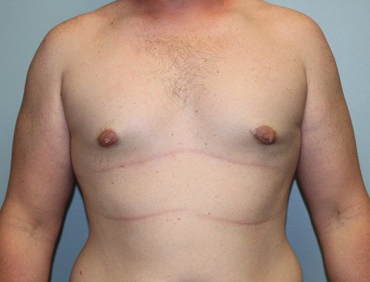 Gynecomastia Before & After