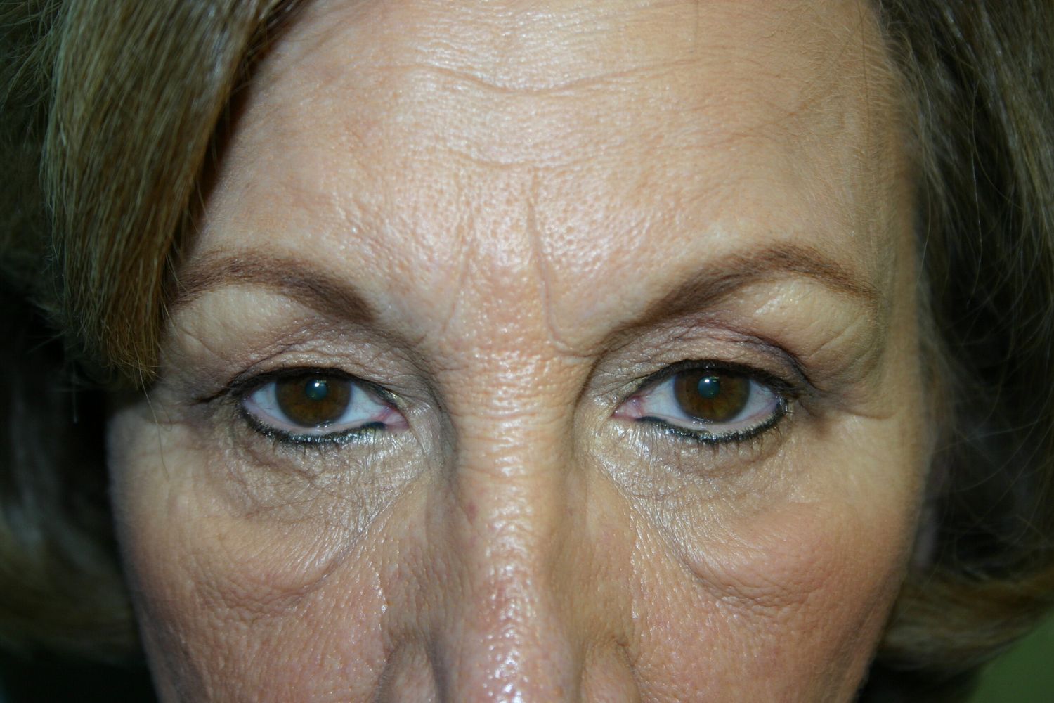 Eyelid Surgery Before & After