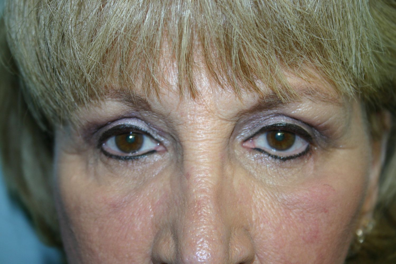 Eyelid Surgery Before & After