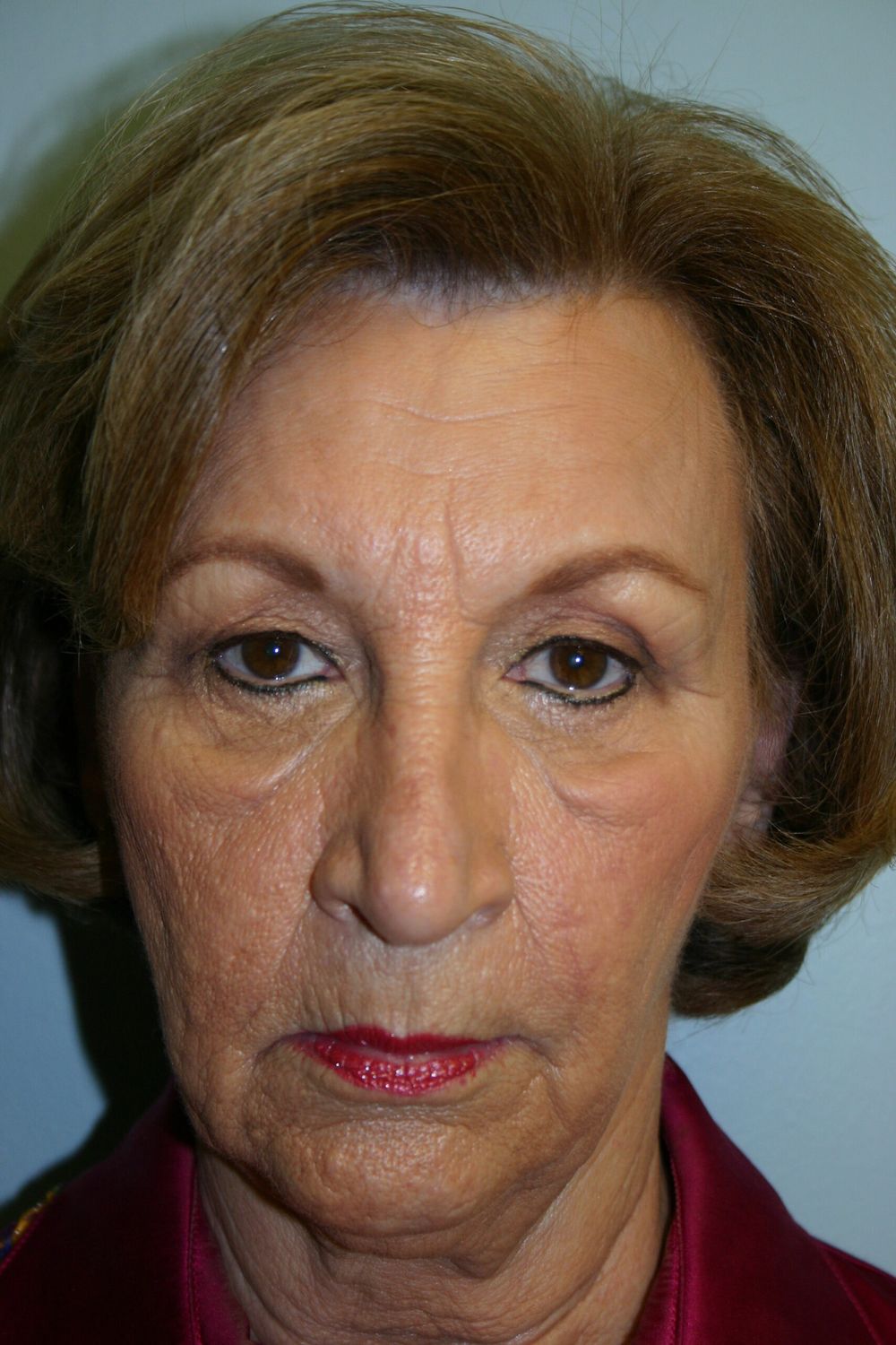 Eyelid Surgery Before & After