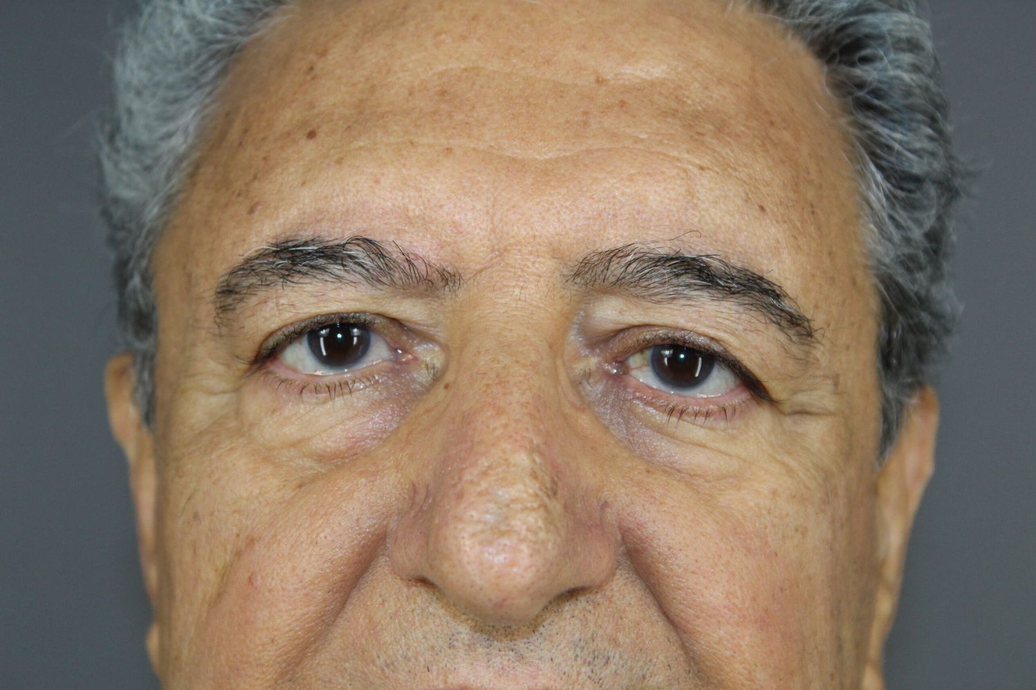 Eyelid Surgery Before & After