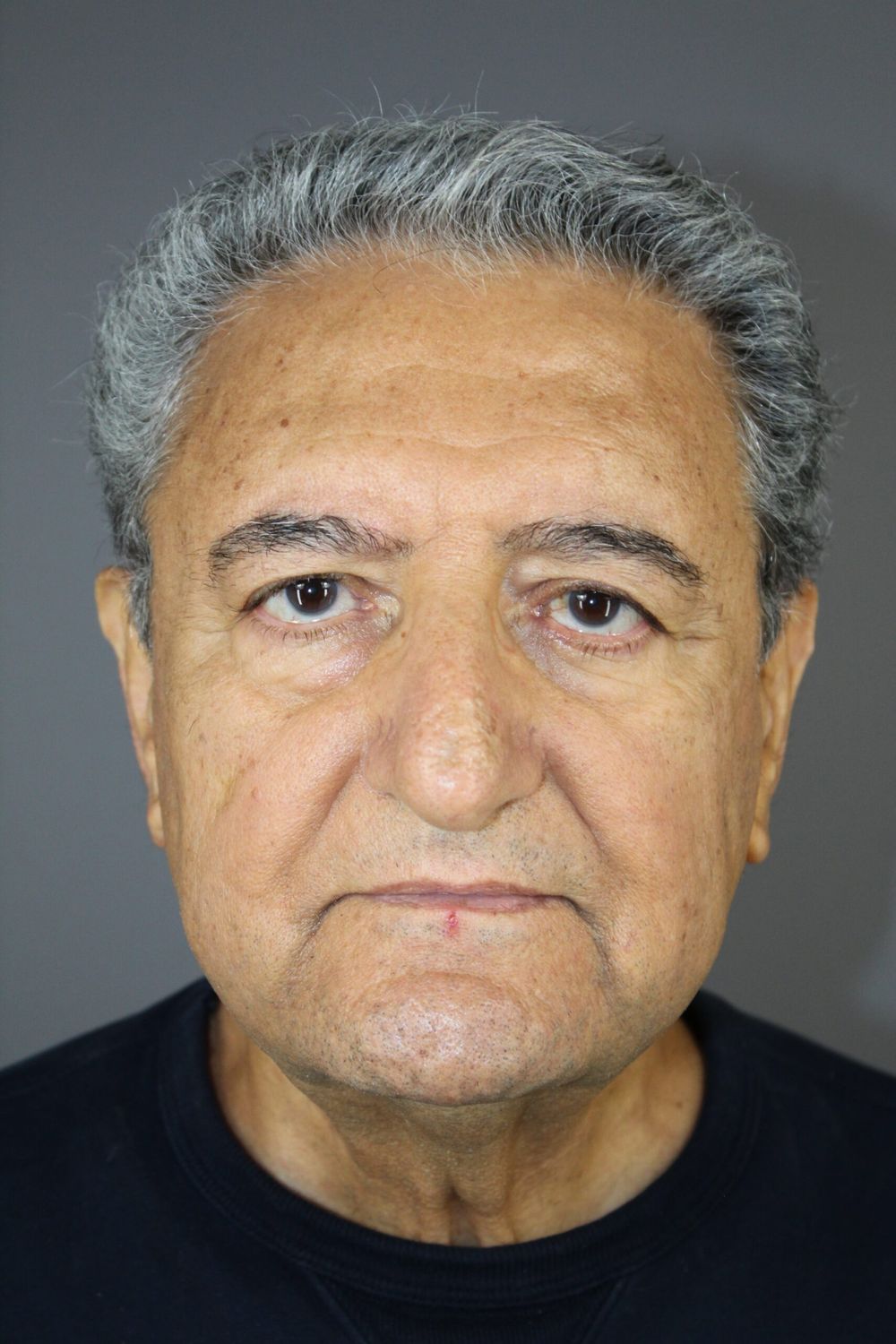 Eyelid Surgery Before & After