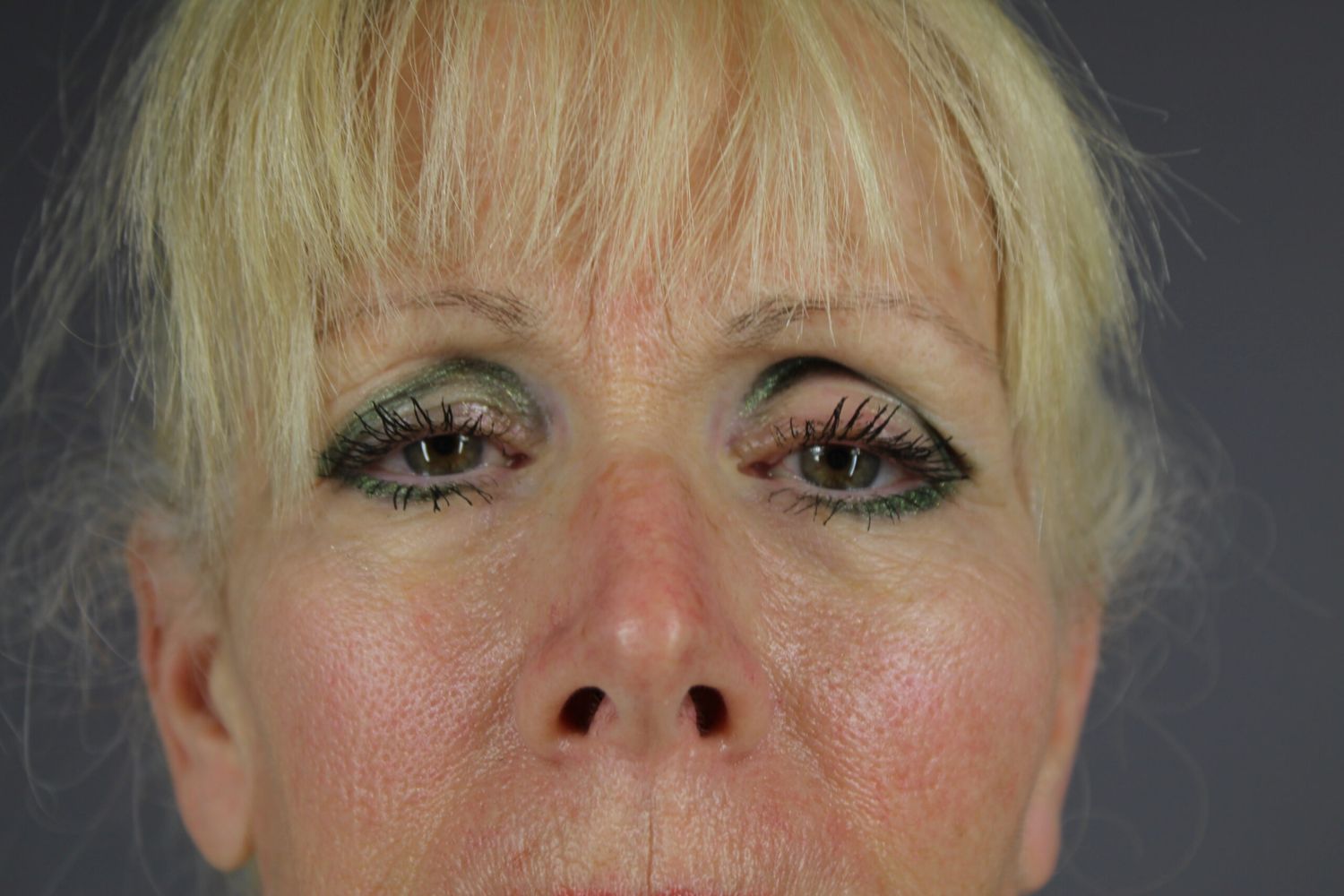 Eyelid Surgery Before & After