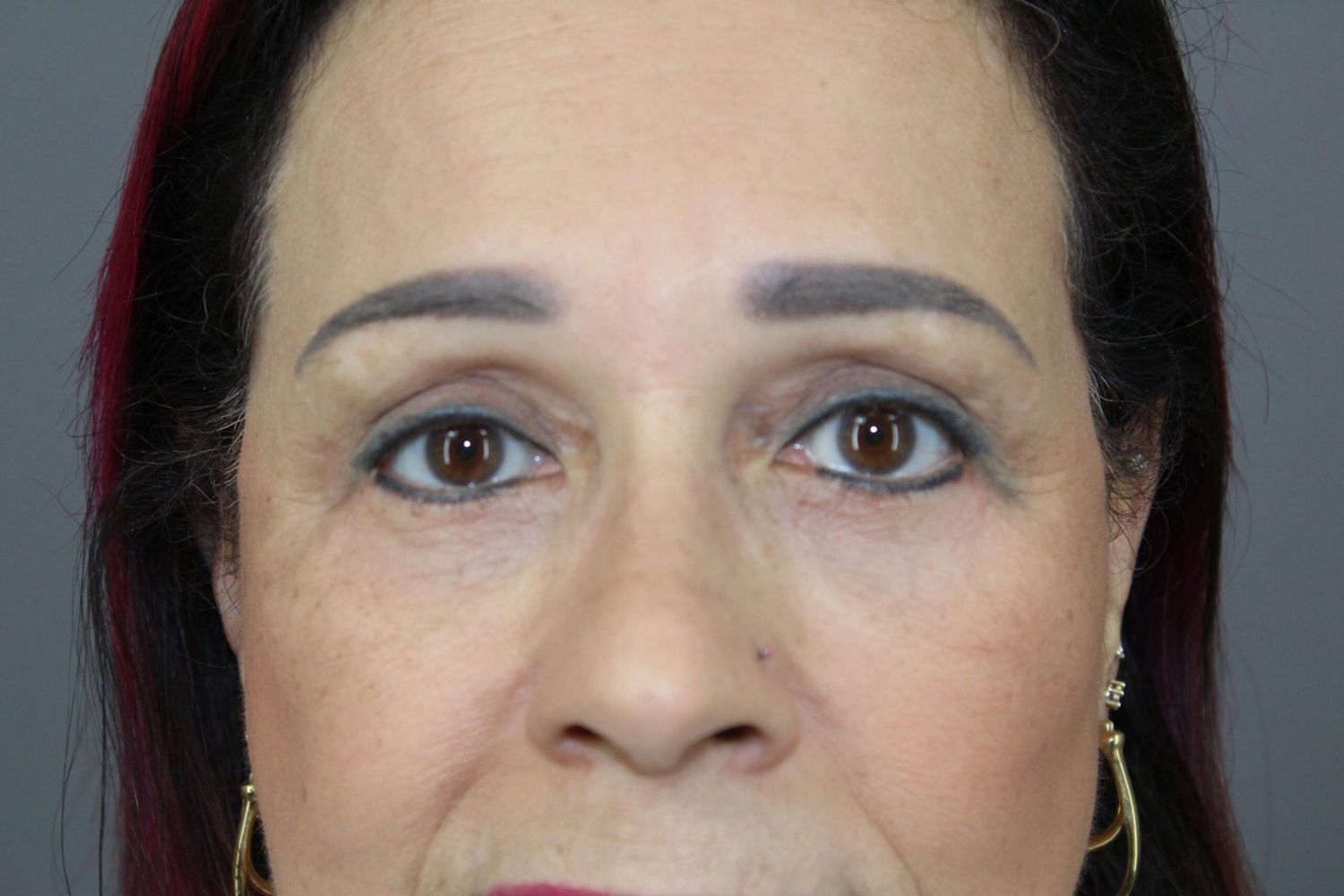 Eyelid Surgery Before & After