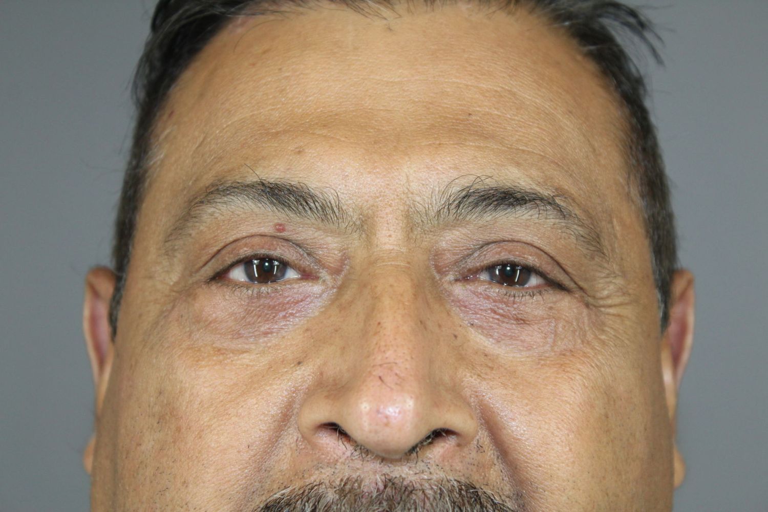 Eyelid Surgery Before & After