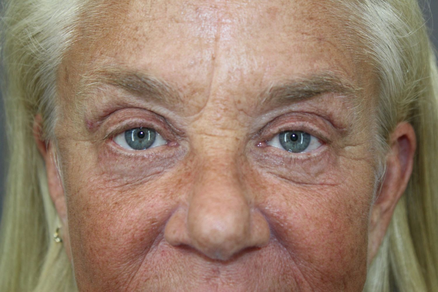Eyelid Surgery Before & After