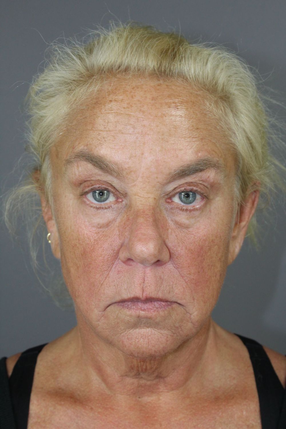 Eyelid Surgery Before & After