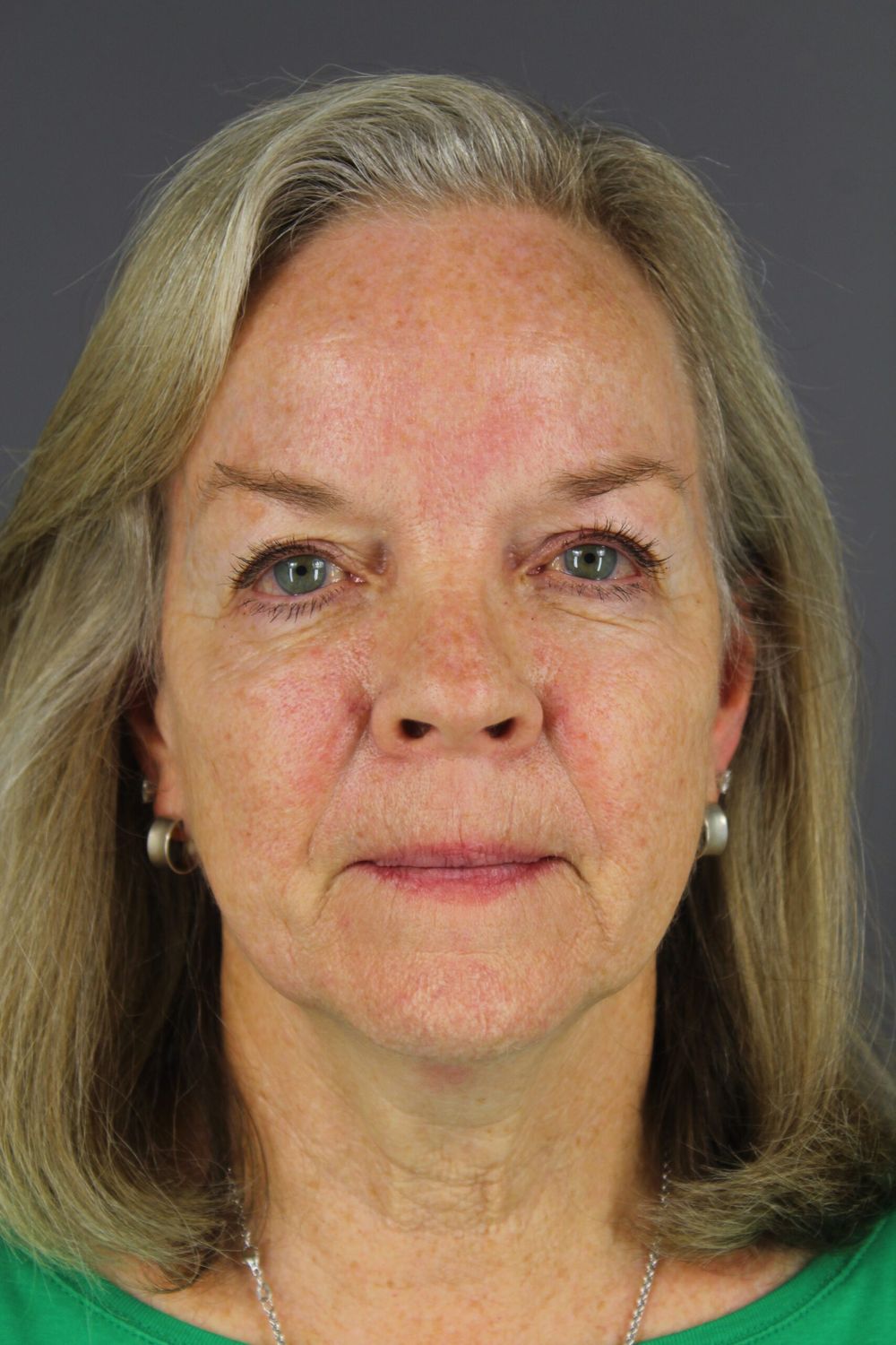 Eyelid Surgery Before & After