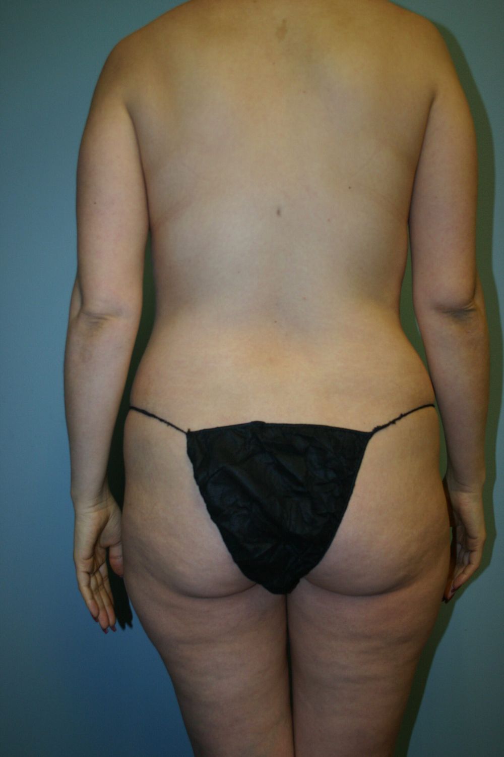 Brazilian Butt Lift Before & After