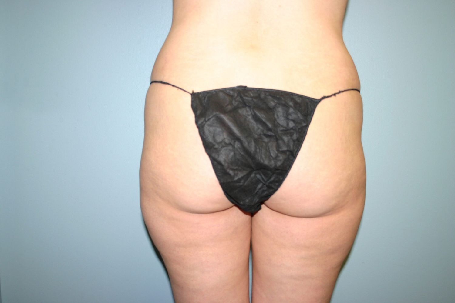 Brazilian Butt Lift Before & After