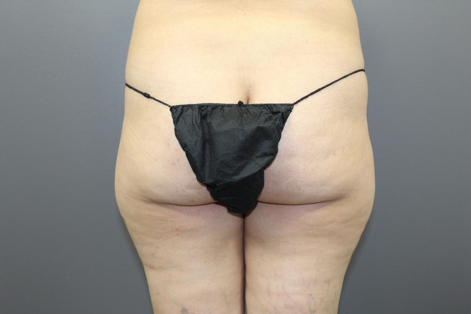 Brazilian Butt Lift Before & After