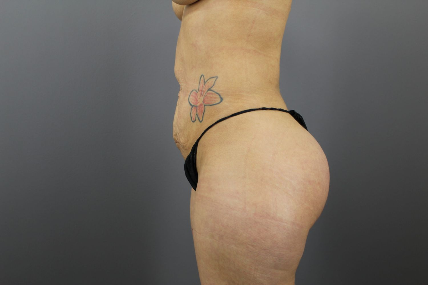 Brazilian Butt Lift Before & After