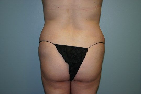 Brazilian Butt Lift Before & After