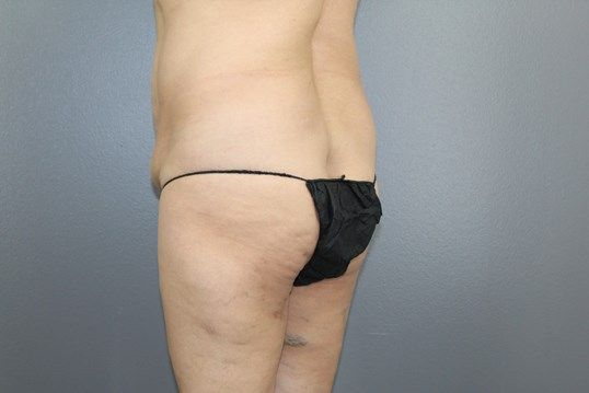 Brazilian Butt Lift Before & After