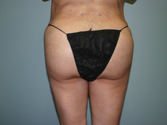 Brazilian Butt Lift Before & After