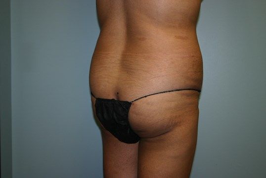 Brazilian Butt Lift Before & After