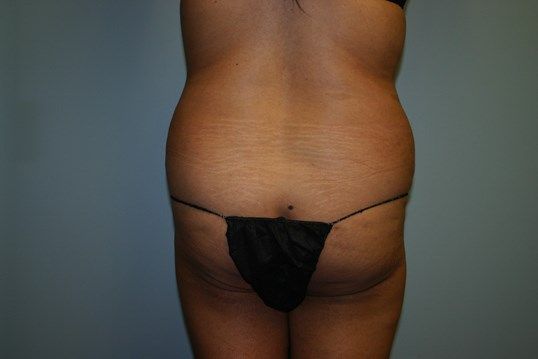Brazilian Butt Lift Before & After