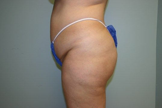 Brazilian Butt Lift Before & After