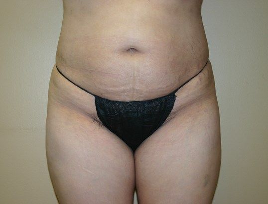 Brazilian Butt Lift Before & After