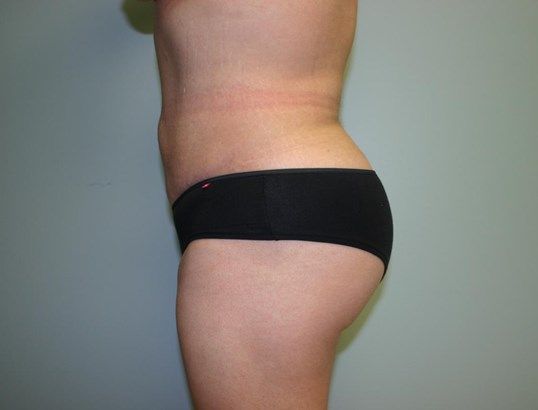 Brazilian Butt Lift Before & After