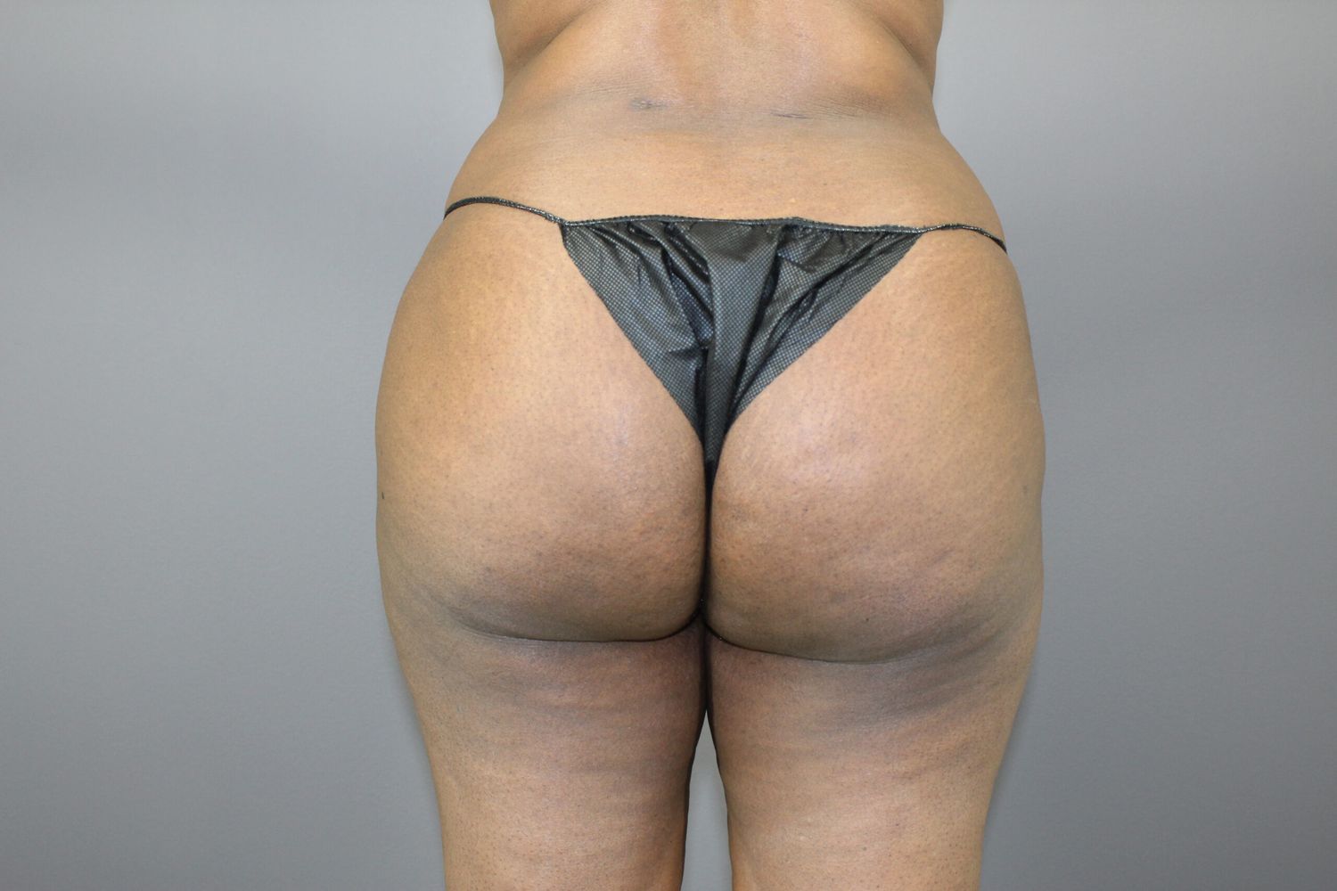 Brazilian Butt Lift Before & After