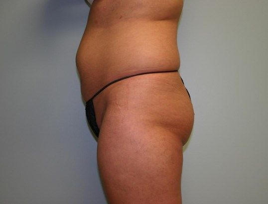 Brazilian Butt Lift Before & After