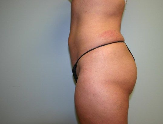Brazilian Butt Lift Before & After