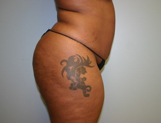 Brazilian Butt Lift Before & After