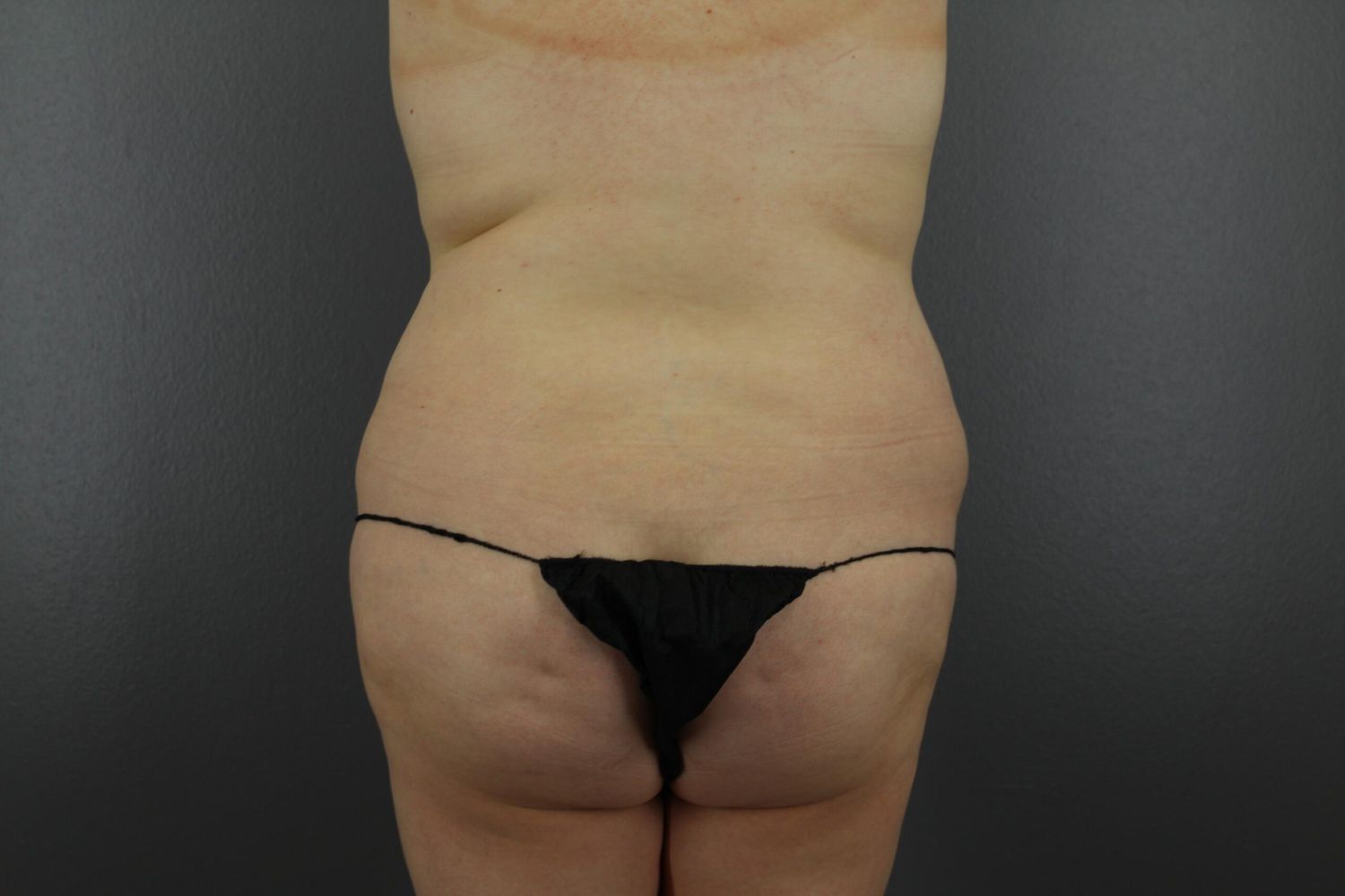 Brazilian Butt Lift Before & After