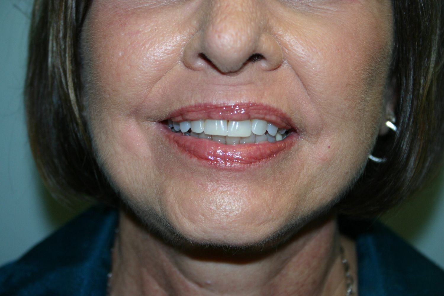 Croton Oil Peel Before & After