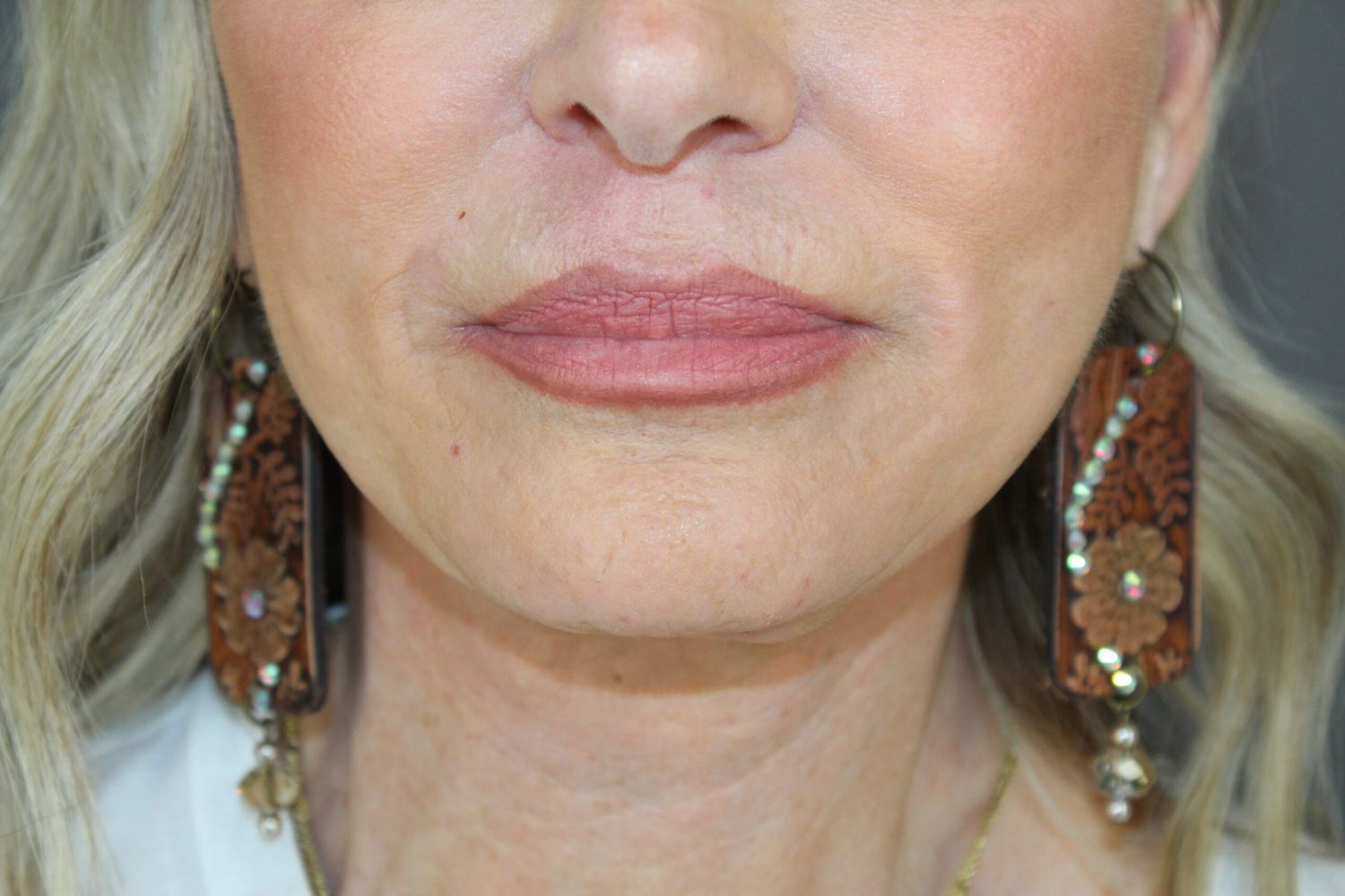 Croton Oil Peel Before & After