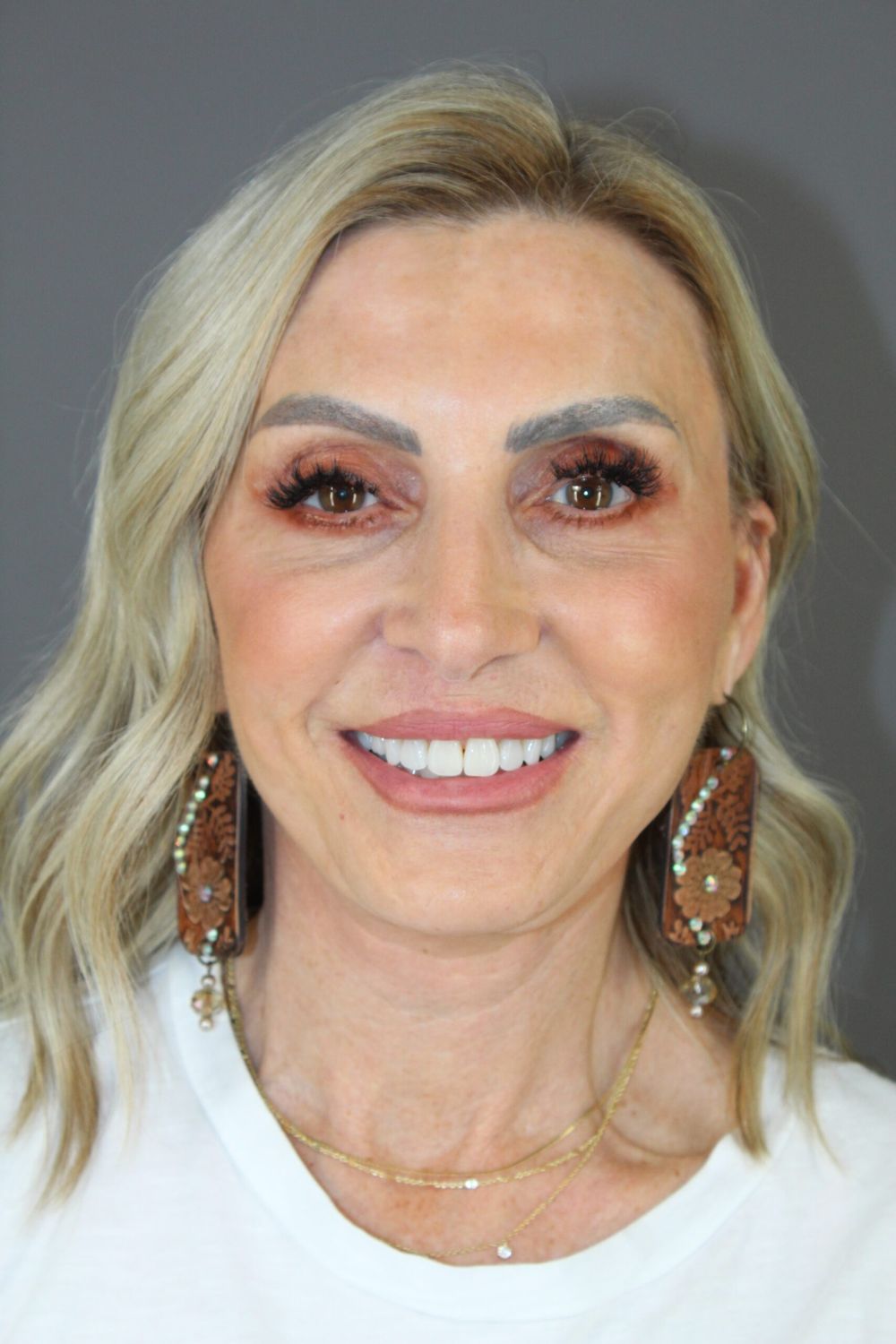 Croton Oil Peel Before & After