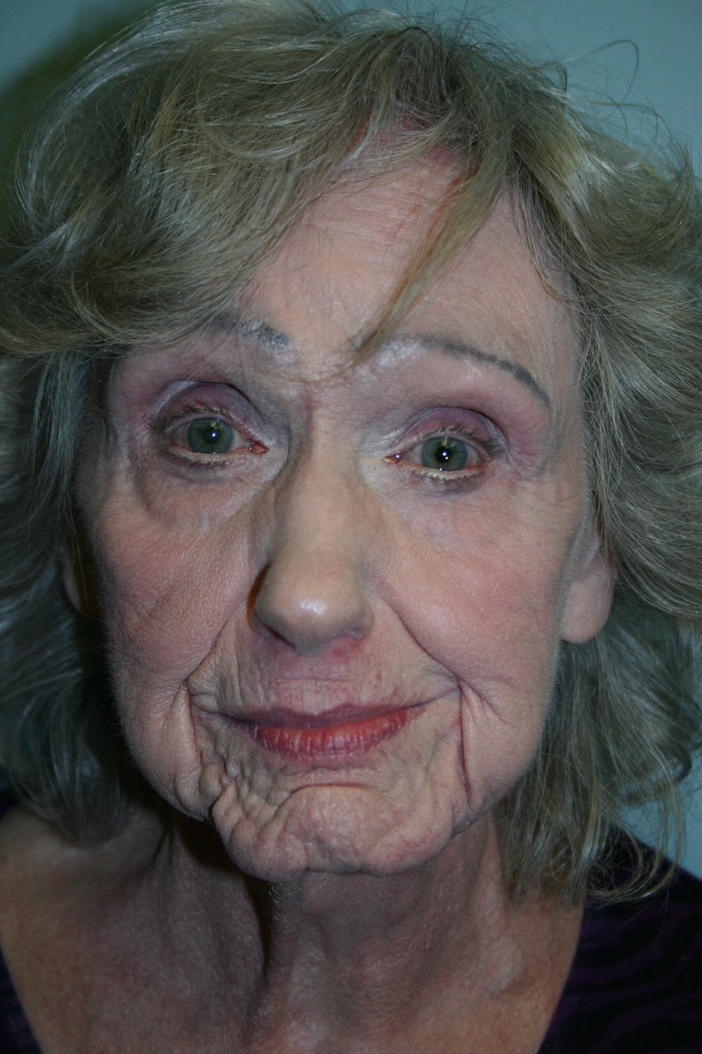 Croton Oil Peel Before & After