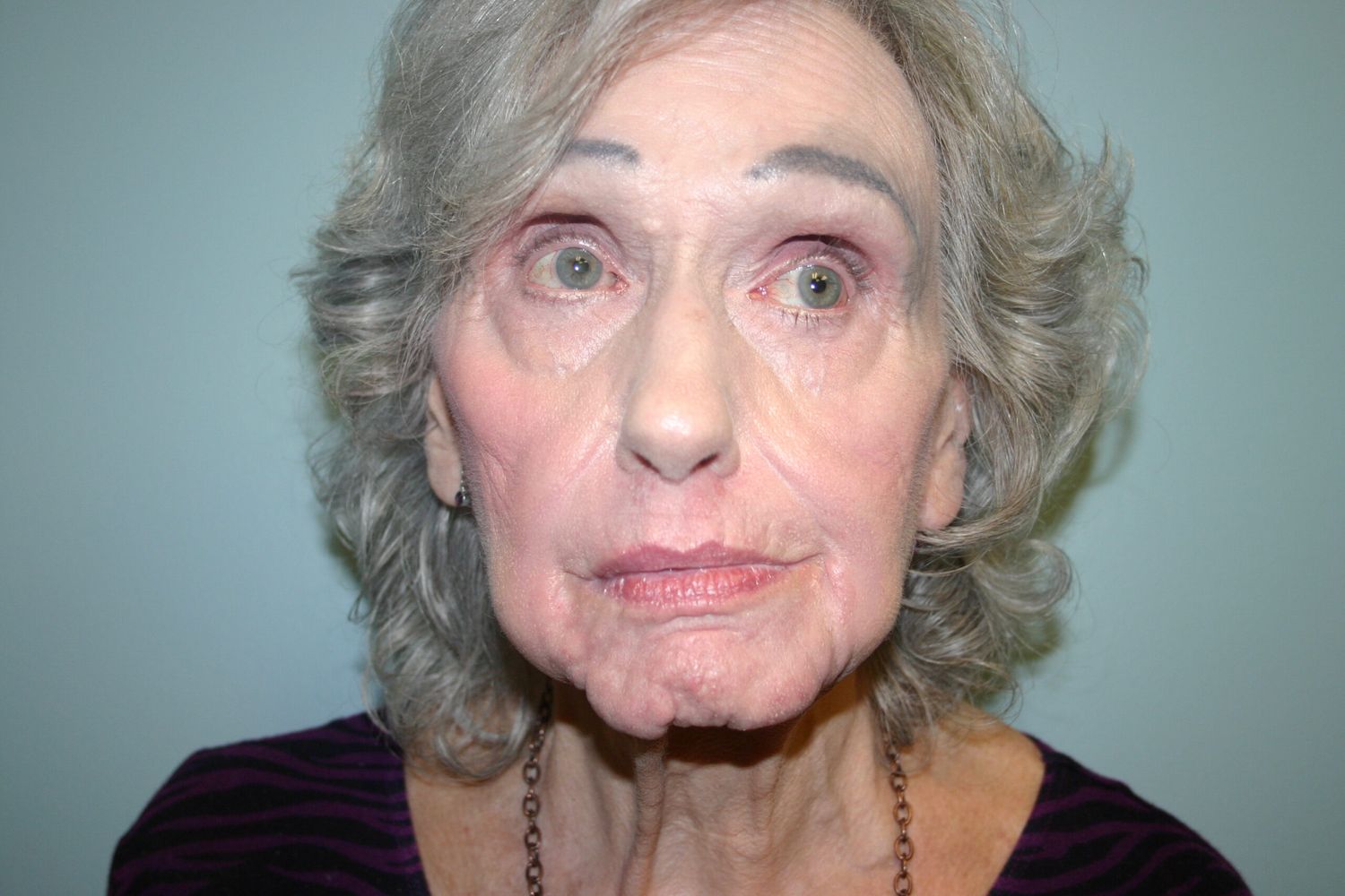 Croton Oil Peel Before & After