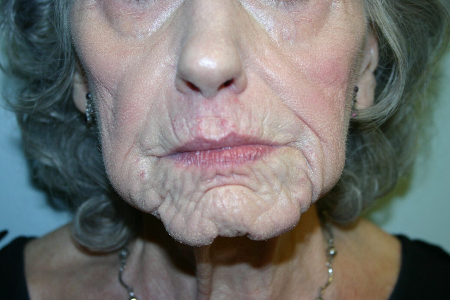 Croton Oil Peel Before & After