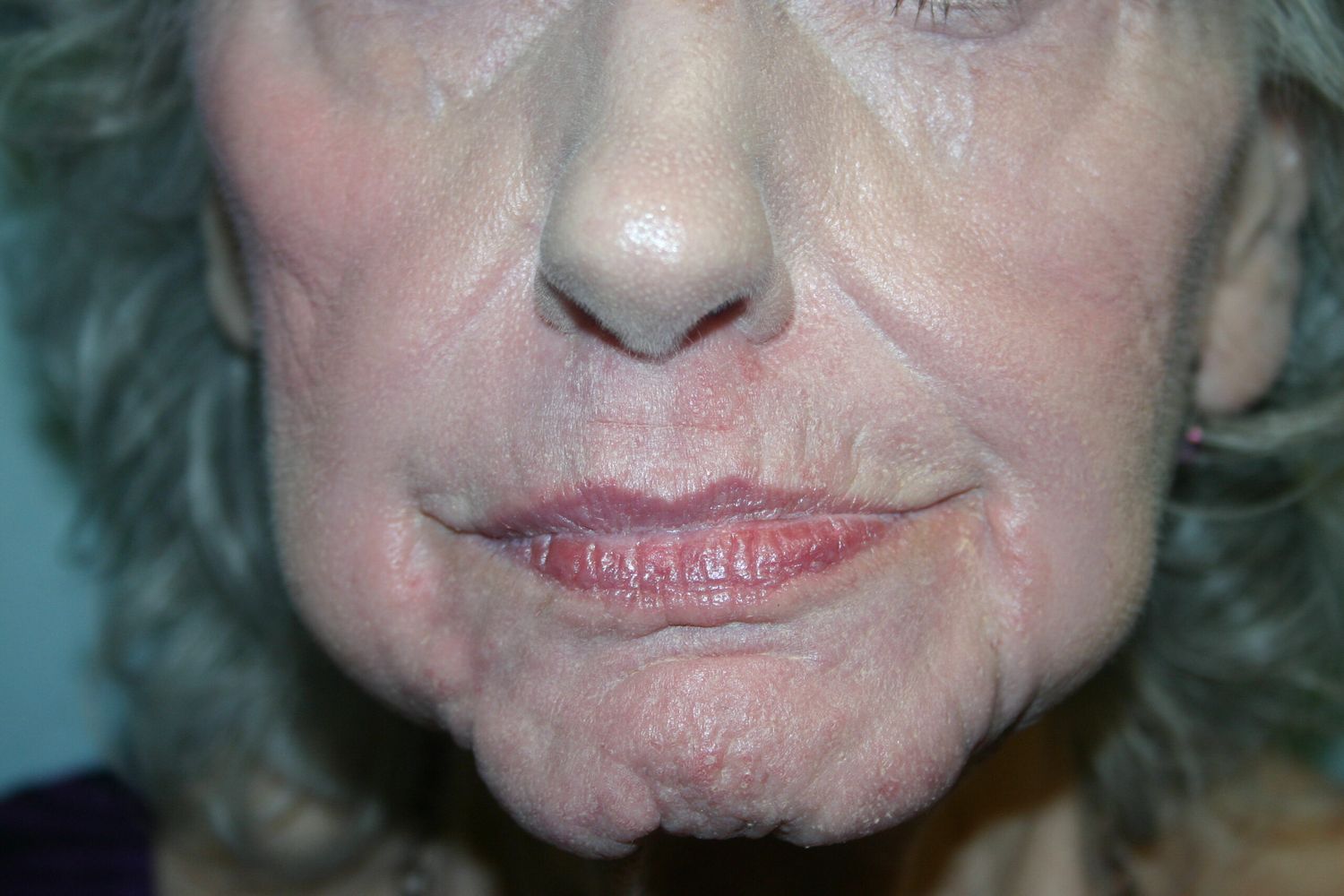 Croton Oil Peel Before & After