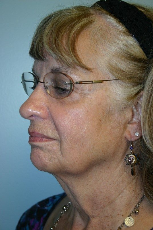 Croton Oil Peel Before & After