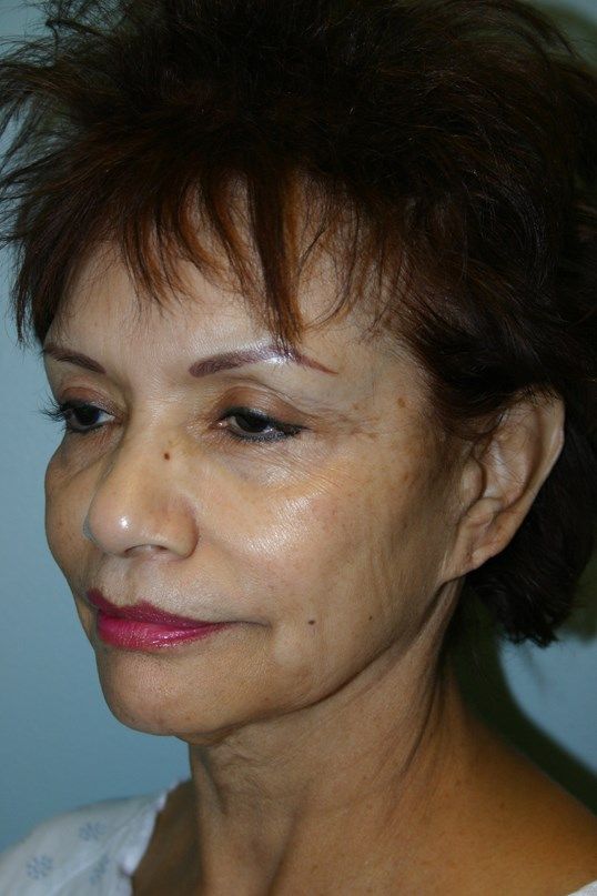 Croton Oil Peel Before & After