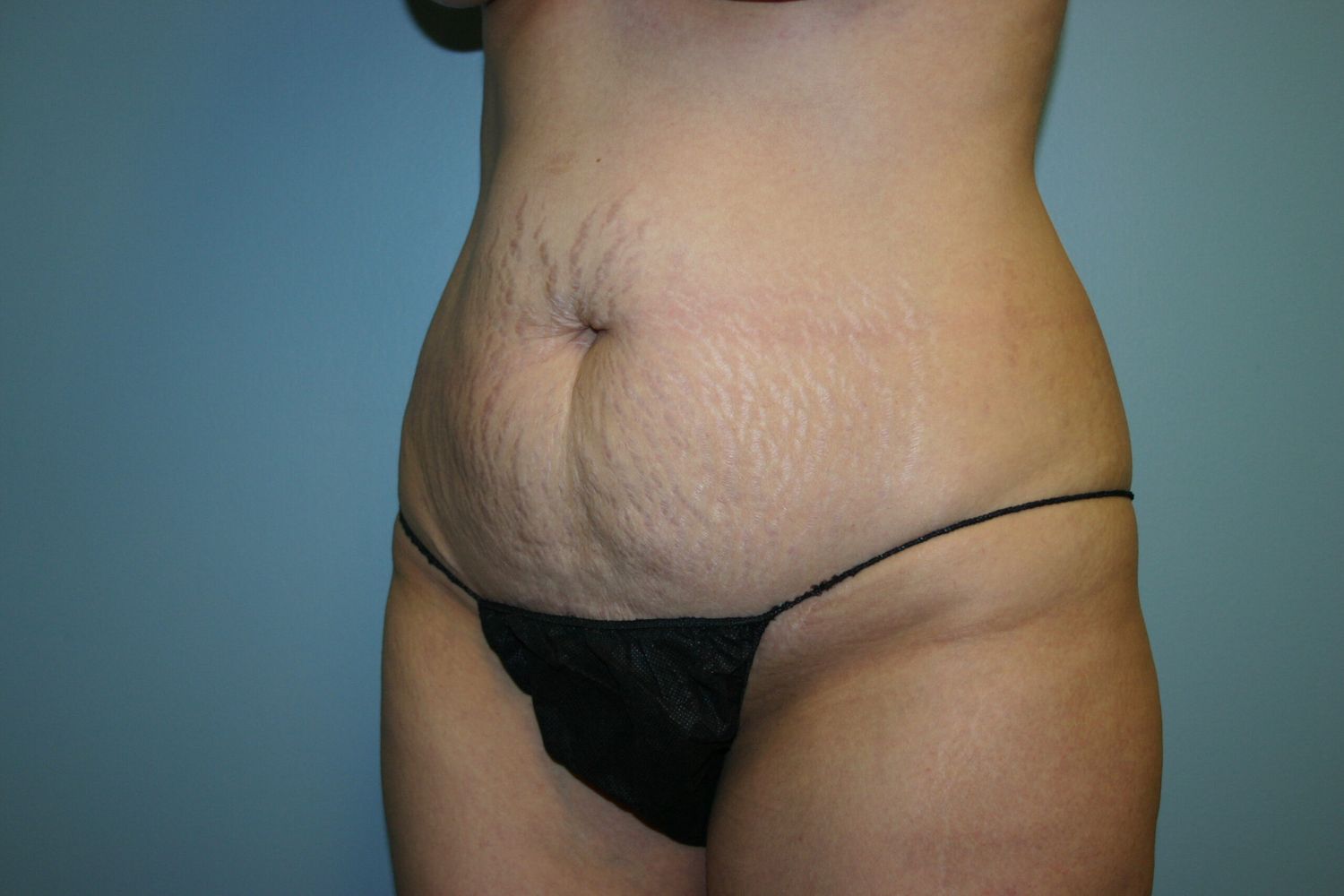 Liposuction Before & After