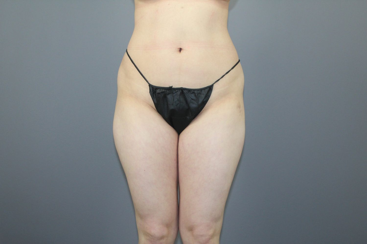 Liposuction Before & After