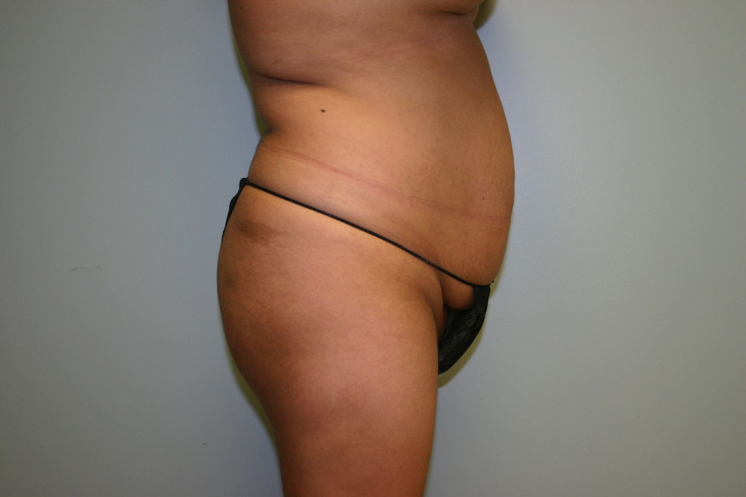 Liposuction Before & After