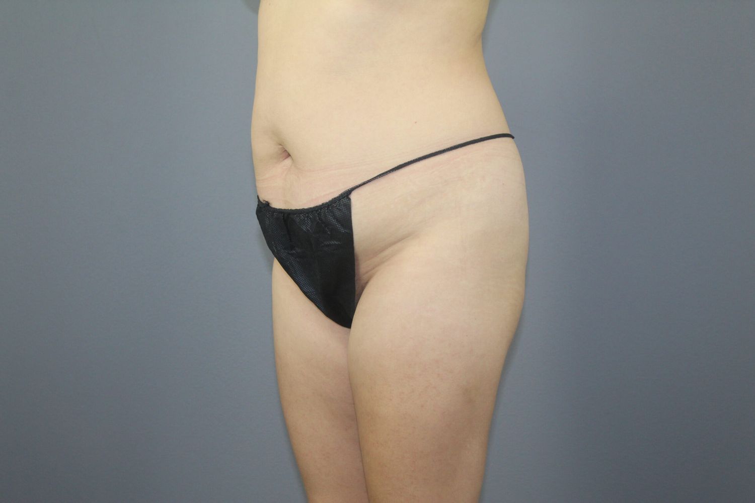 Liposuction Before & After